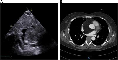 The characteristics of invasive cardiac lipoma: case report and literature review